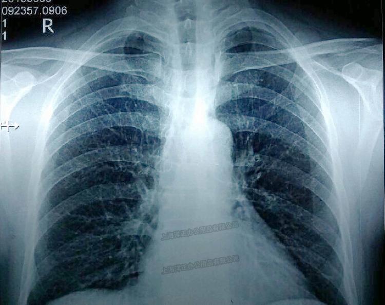 阿娇导医 |x光片能筛查出早期肺癌吗?