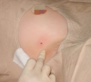 3mm切口拿下3cm大小乳腺肿瘤,重庆北部宽仁医院开展麦默通微创手术