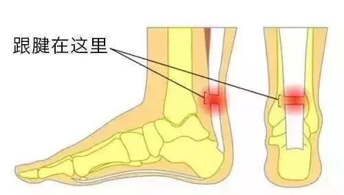 又见球星跟腱断裂 普通人更要当心跟腱"过劳断"