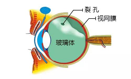 玻璃体后脱离是"坏蚊子"最主要的病因,那么什么是玻璃体后脱离呢?