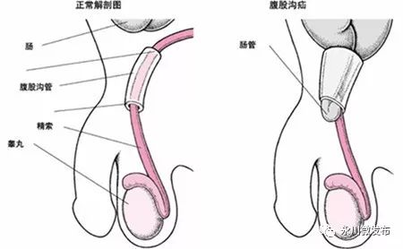 腹股沟斜疝走向图片