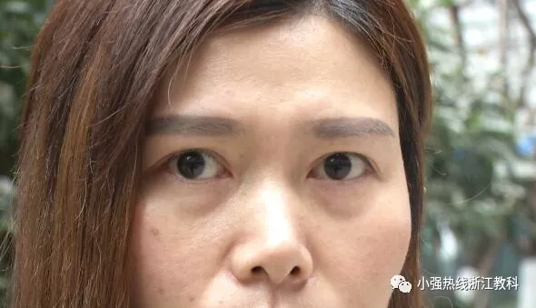 35岁女子花18000割双眼皮后下垂 医院:因地球引力