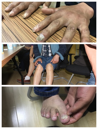 五周的手指、脚趾及膝盖上都留有当年遭拷打的痕迹。（孔华/摄）