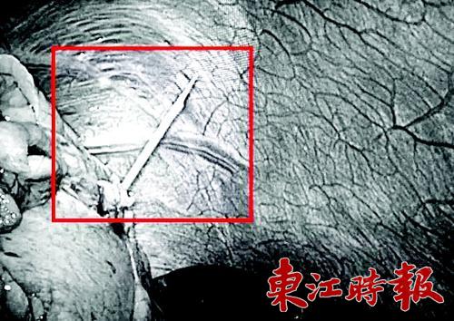 通过CT检查发现，半截牙签已经戳破该男子的胃。《东江时报》记者周智聪 通讯员肖凌晖 摄
