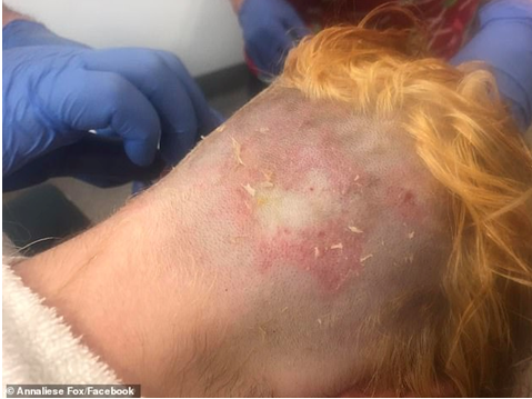 20岁女孩自己动手漂头发结果遭受严重的化学烧伤需植皮