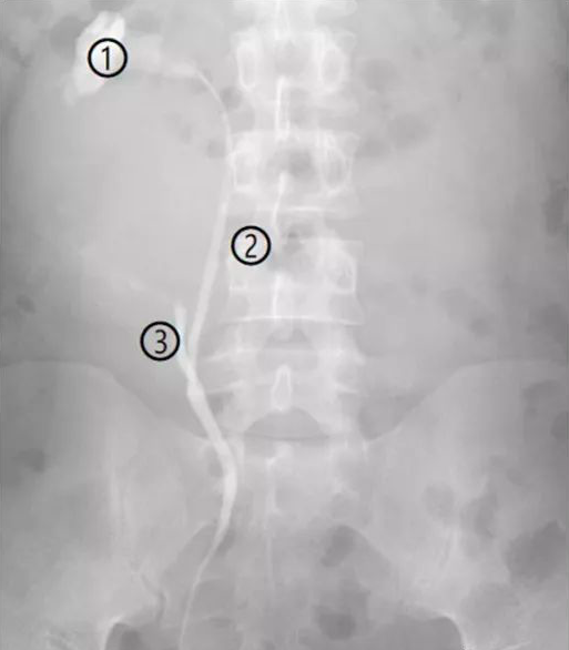 劉先生入院後,經過ct檢查,病情提示馬蹄腎,雙腎囊腫(右腎較大),左側輸