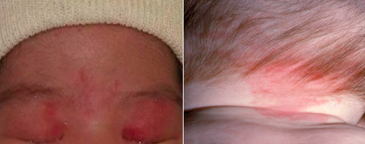 宝宝额头血管畸形图片图片