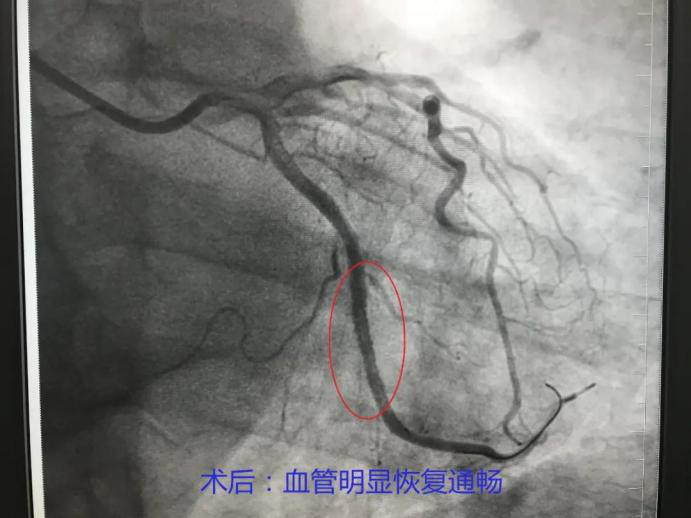 冠狀動脈造影可為冠心病診斷提供可靠的解剖和功能的信息,為評價預後