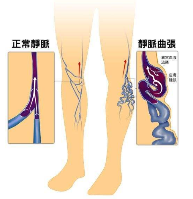 血管突出成