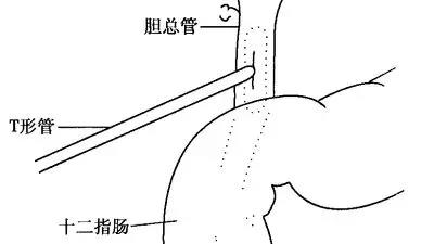 t型管放置位置图片图片