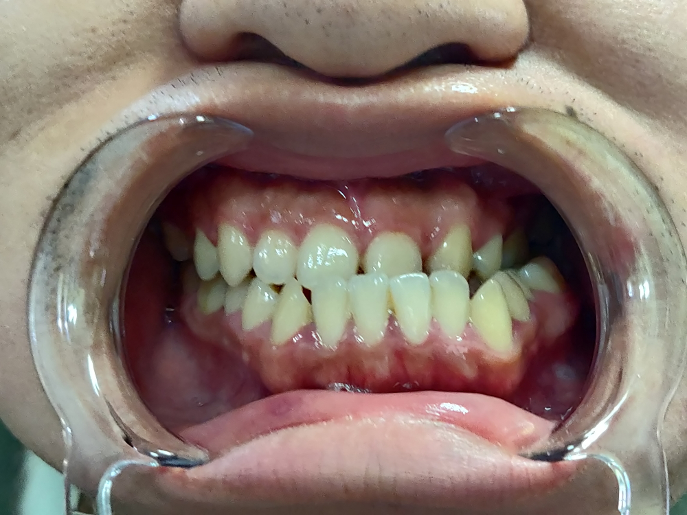 牙颌面畸形人的脸型图片