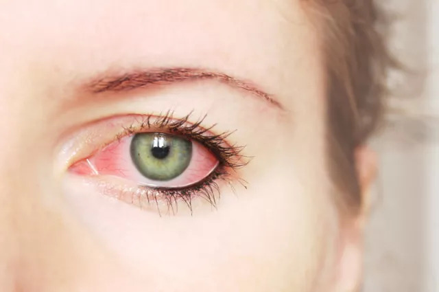把过敏性结膜炎当成红眼病来治?小心症状加重