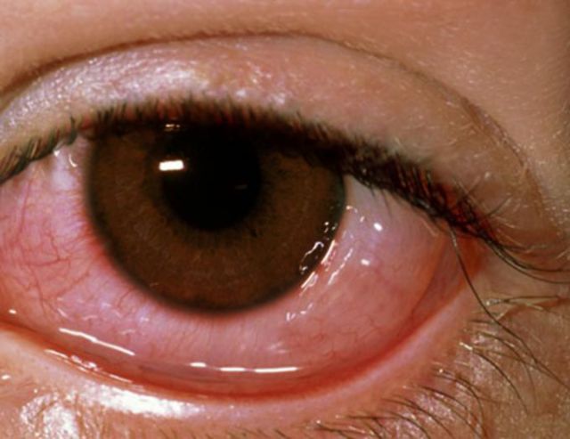 红眼病的早期症状图图片