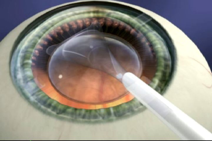 为什么眼睛摘除白内障后还要放入人工晶体呢?