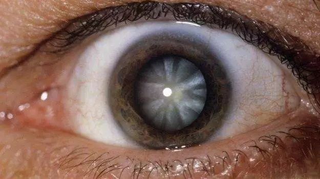这些容易引发青光眼的症状你有吗别让青光眼悄无声息的偷走你的视力