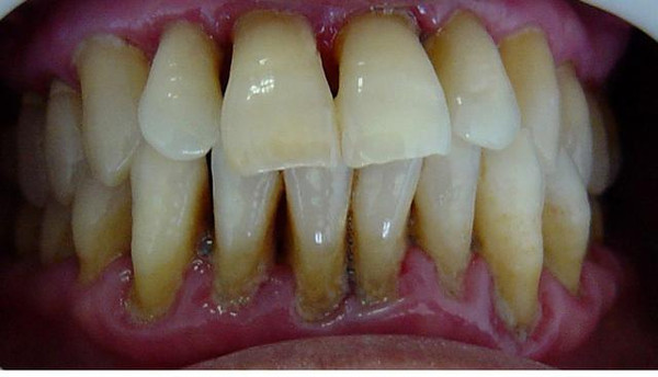牙刷|不要小看牙龈出血，会引发一系列疾病，电动牙刷一定要用！