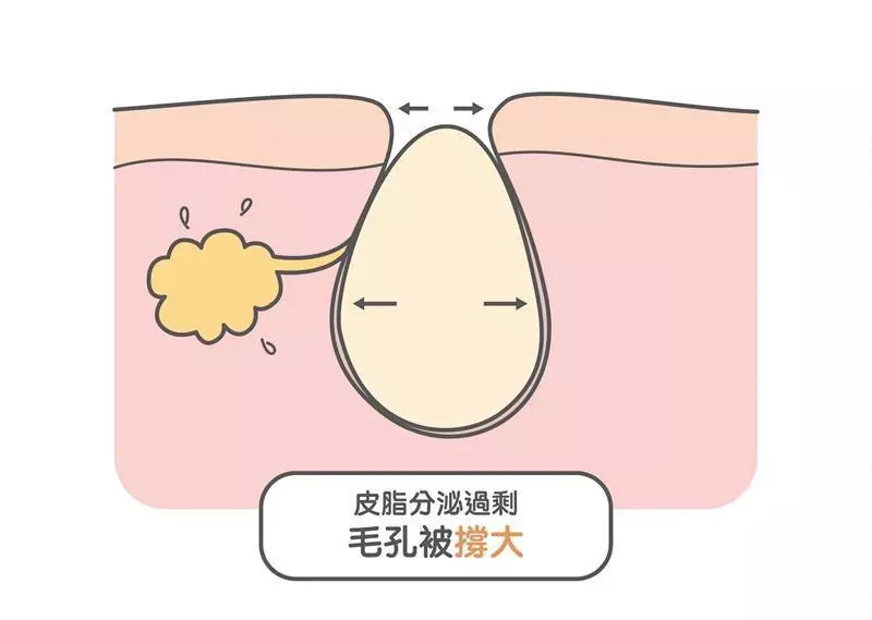 以t字部位和脸颊部位的皮脂腺分布最密集,毛孔最为粗大.